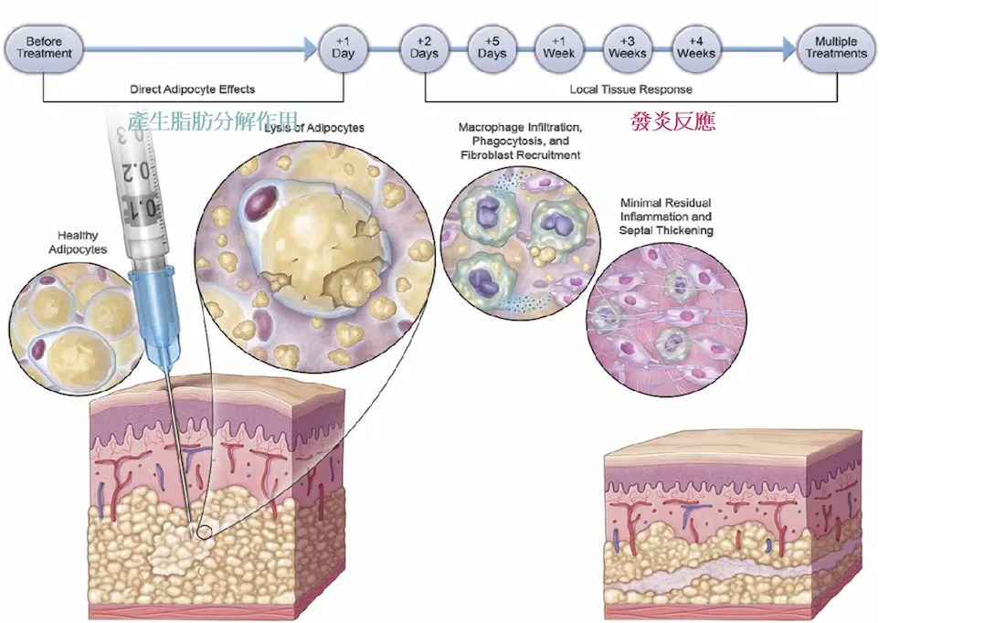 溶脂針推薦6