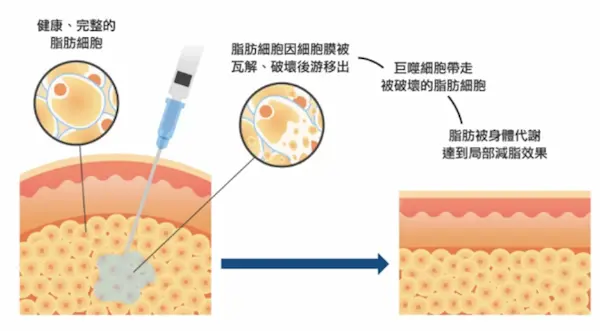 溶脂針推薦8